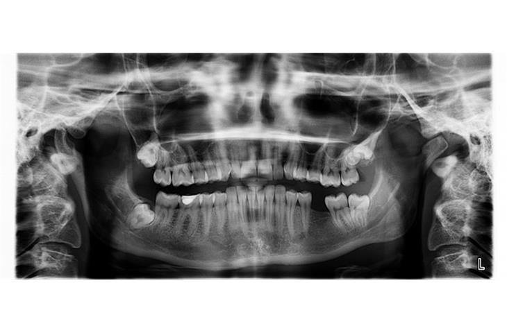 Enhancing Breast X-ray Imaging Performance Testing Equipment